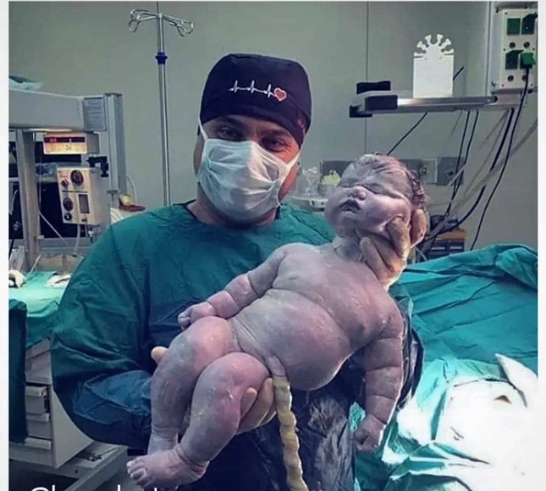 KnowIedgehubb's tweet photo. The biggest baby by natural vaginal birth weighing roughly 17.47 pounds (7.9kg) and 22.5 inches (57.5cm ) long! https://t.co/BHQEqIBqH4