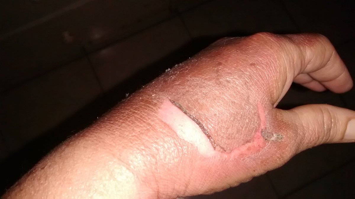 Sarah_SCaceres's tweet photo. Hello friends. My mom got a bad burn on her hand. It's already hard to support my daughter and now I have to help my mom with her treatment before her hand gets worse. Please help me by donating or RT. God bless you.
#MutualAid
 https://t.co/gsK3jFKGdh https://t.co/USrihZlxkj
