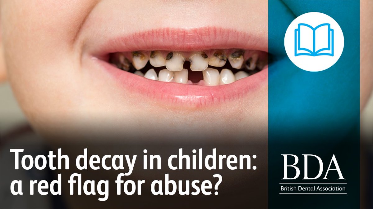TheBDA's tweet photo. When does childhood dental caries become neglect or abuse: do parents think what dentists think?

📘 https://t.co/uCjayVx8al https://t.co/KTBLdq9NKg
