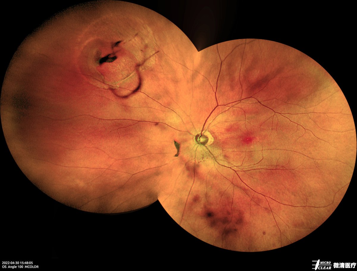 Microcleartec's tweet photo. #Retinalhole #Retinaldegeneration
Pictured by Microclear Medical Apollo, the #ConfocalRetinalOphthalmoscope at @Zhejiang Provincial People's Hospital
#retinopathy #funduscamera #ophthalmic #ophthalmology https://t.co/5DpfYtZ7Ia