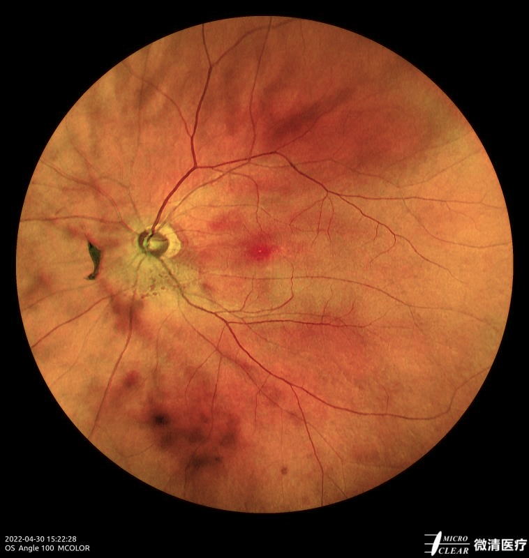 Microcleartec's tweet photo. #Retinalhole #Retinaldegeneration
Pictured by Microclear Medical Apollo, the #ConfocalRetinalOphthalmoscope at @Zhejiang Provincial People's Hospital
#retinopathy #funduscamera #ophthalmic #ophthalmology https://t.co/5DpfYtZ7Ia