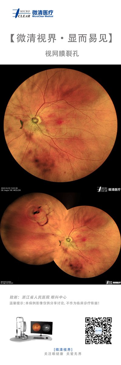 #Retinalhole #Retinaldegeneration
Pictured by Microclear Medical Apollo, the #ConfocalRetinalOphthalmoscope at <a href="/Zhejiang/">浙江新闻</a> Provincial People's Hospital
#retinopathy #funduscamera #ophthalmic #ophthalmology