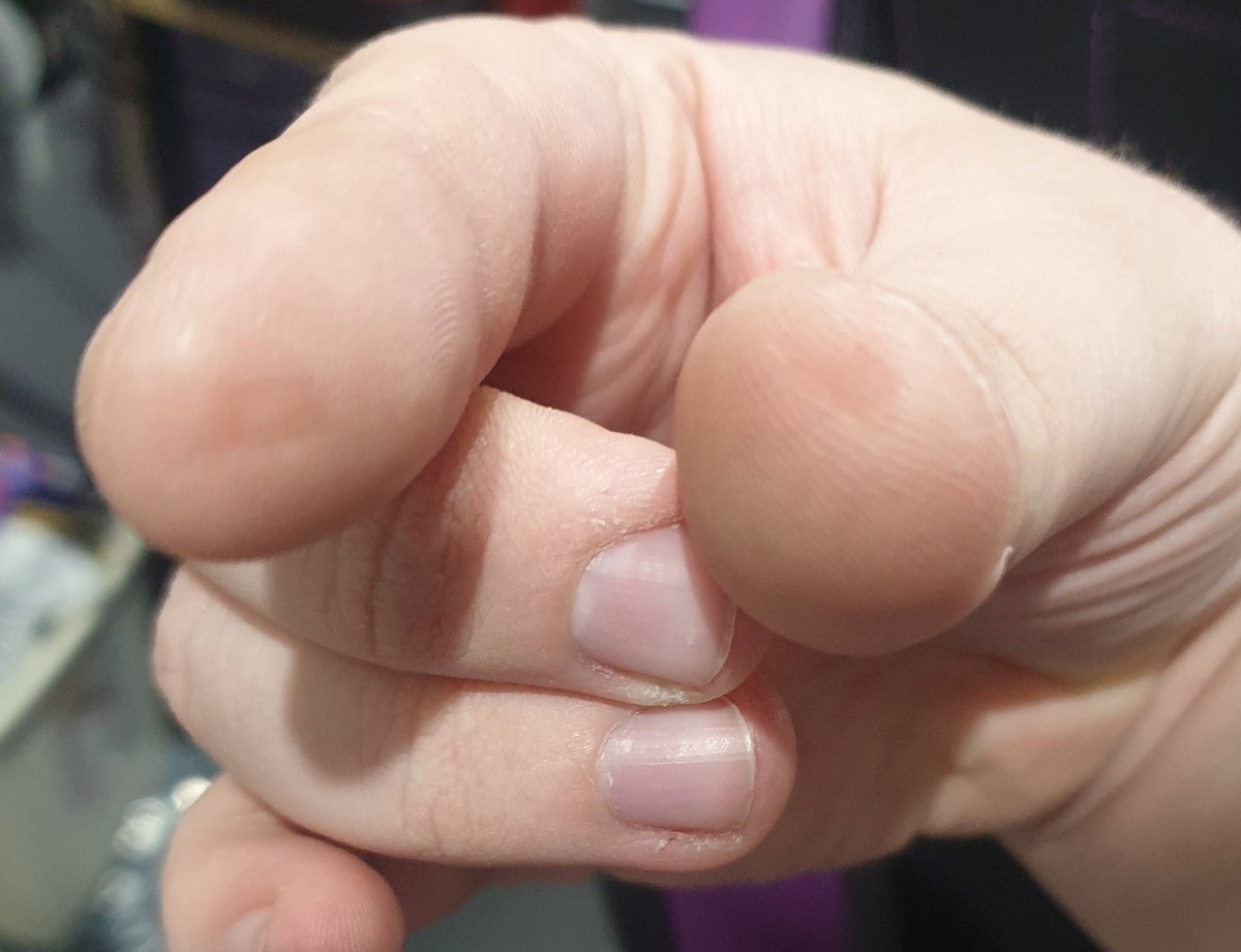 Replacing the nozzle on my 3d printer, forgot things get hot and now I'm missing parts of my fingerprints. Good effort.