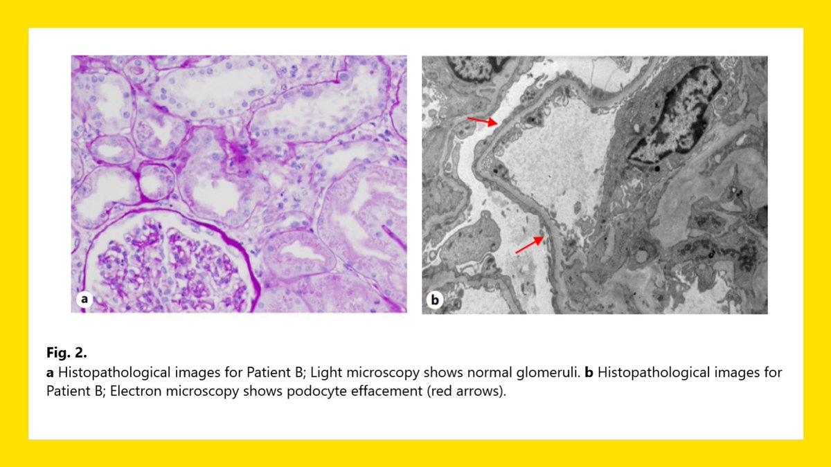 NephroKarger's tweet photo. Minimal Change Disease Secondary to Graft-versus-Host Disease after Allogeneic Hematopoietic #CellTransplant for Myelodysplastic Syndrome
✍ Omar Elghawy
📑 https://t.co/Xto2vQUn0R
#CaseRepNephrolDial #OpenAccess #Graft #KidneyBiopsy #HCT https://t.co/EqszkARJ83
