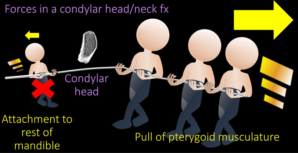 11/So if you ever see a condylar head displaced medially, you know it is a condylar head or neck fracture bc this is where the pterygoids are unopposed and pull medially!