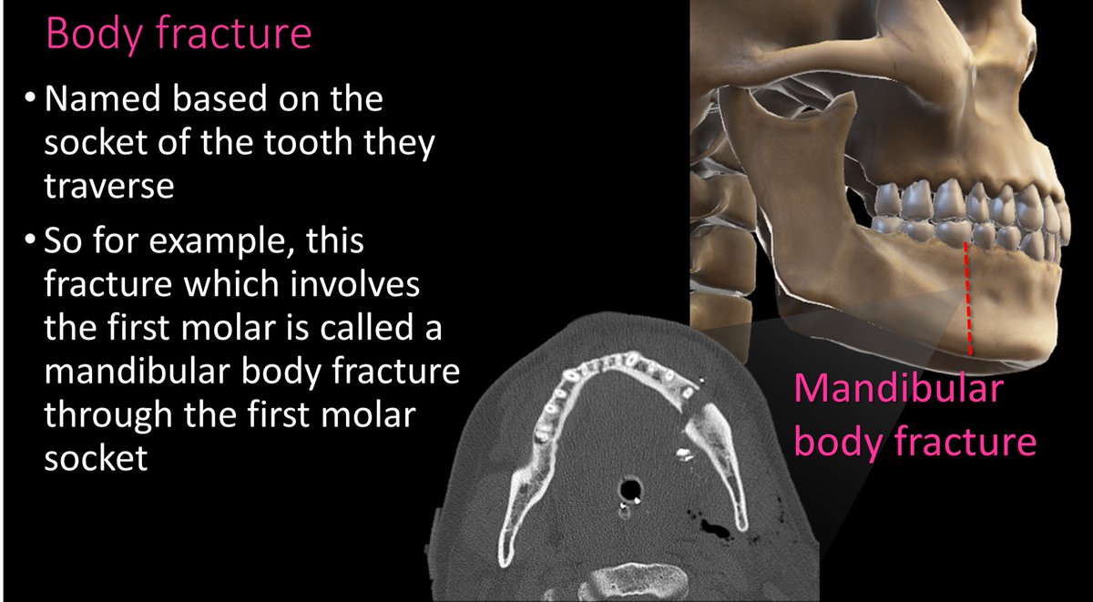 12/Body fxs are through the body of the mandible and are named for the tooth socket that they involve. So you would say “A mandibular body fx through the FILL IN THE BLANK TOOTH socket.”