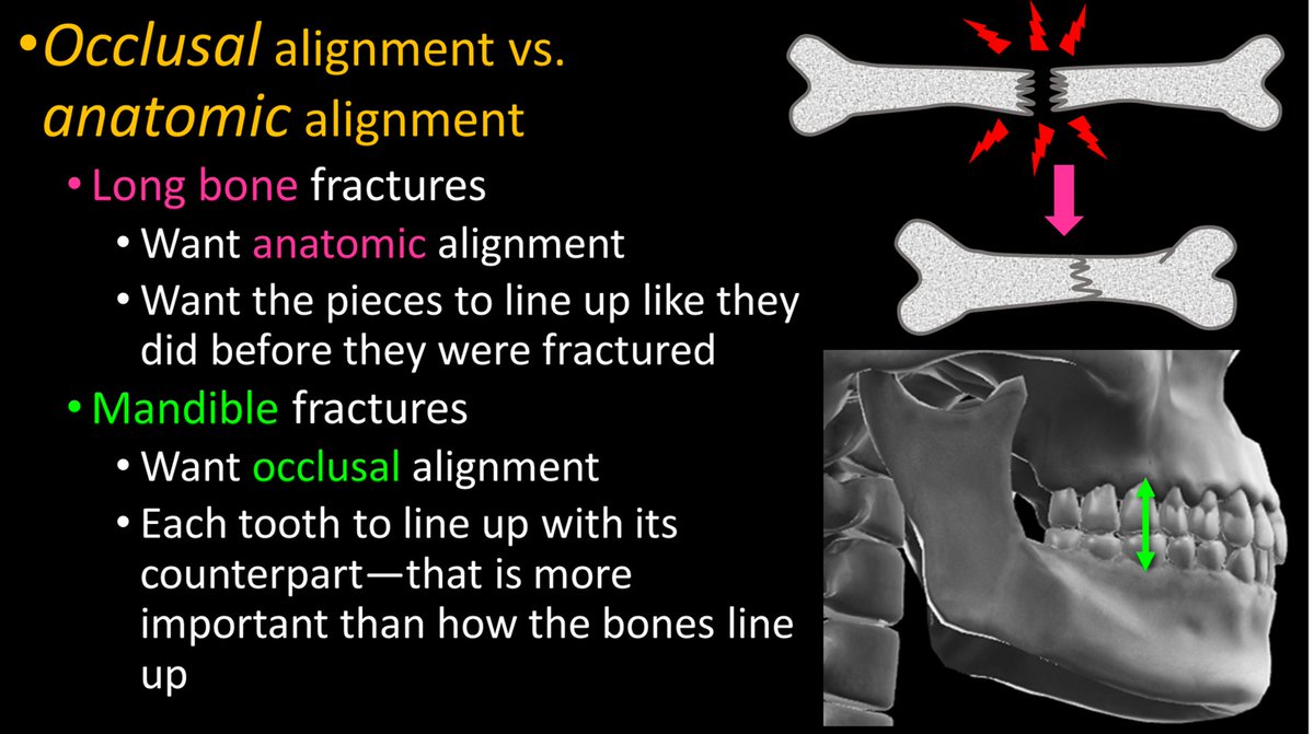 3/Occlusion can be lost w/a fx. The importance of dental occlusion makes mandibular fxs different from other fxs. Usually, we want to fix a bone so that it lines up again. But for the mandible, we want to fix it so the TEETH line up again—so chewing will work.