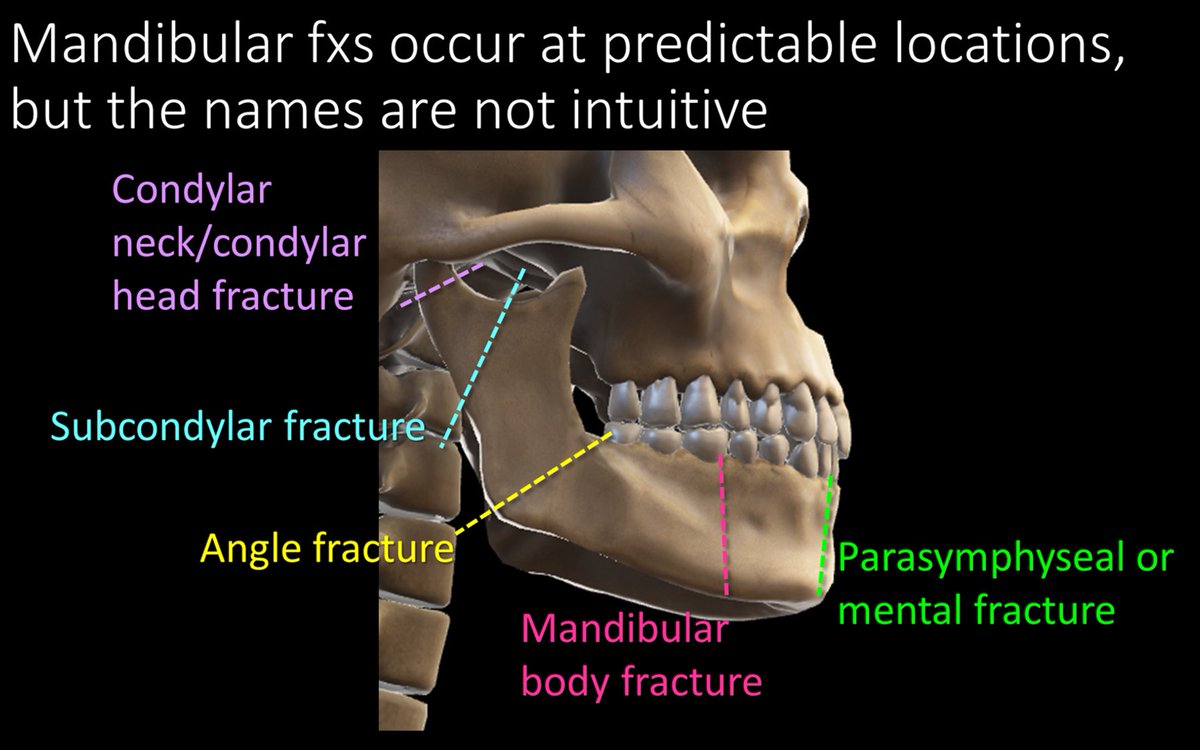 5/Because of the shape of the mandible and the typical forces applied to it, mandibular fractures usually occur at the same few locations. But the names of these fxs are not always intuitive—at least not without a tweetorial to help explain them! 