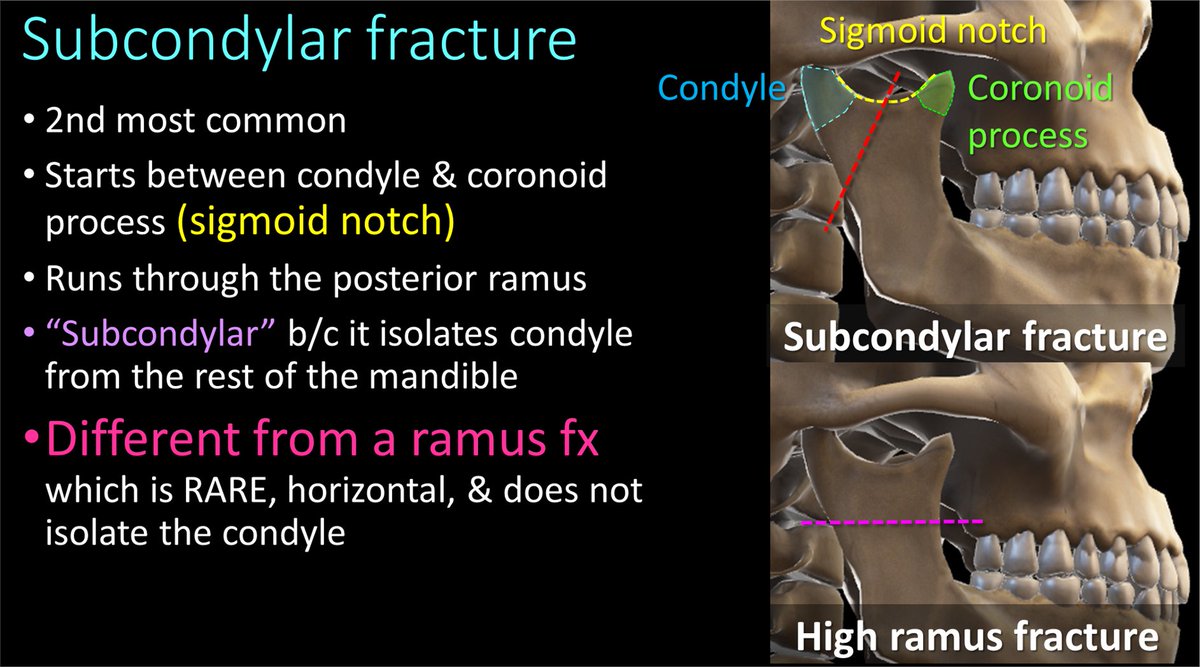 7/A subcondylar fracture starts from the notch between the condyle and coronoid process, called the sigmoid notch and extends into the posterior ramus. Don’t call this a ramus fx bc a ramus fx goes straight horizontally through the ramus!