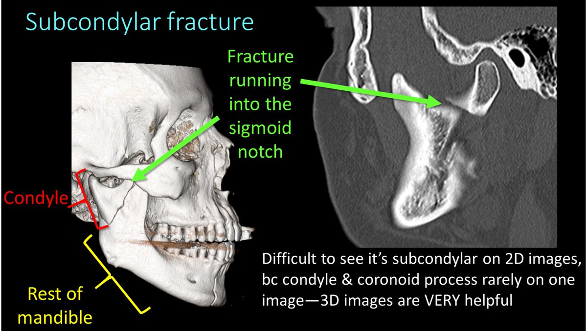 8/Here are examples of subcondylar fxs. A key finding in subcondylar fxs is that it separates the condyle from the rest of the mandible. It can be difficult to see the fx running through the sigmoid notch & ramus on 2D images—3D images can be helpful to see the fx anatomy.