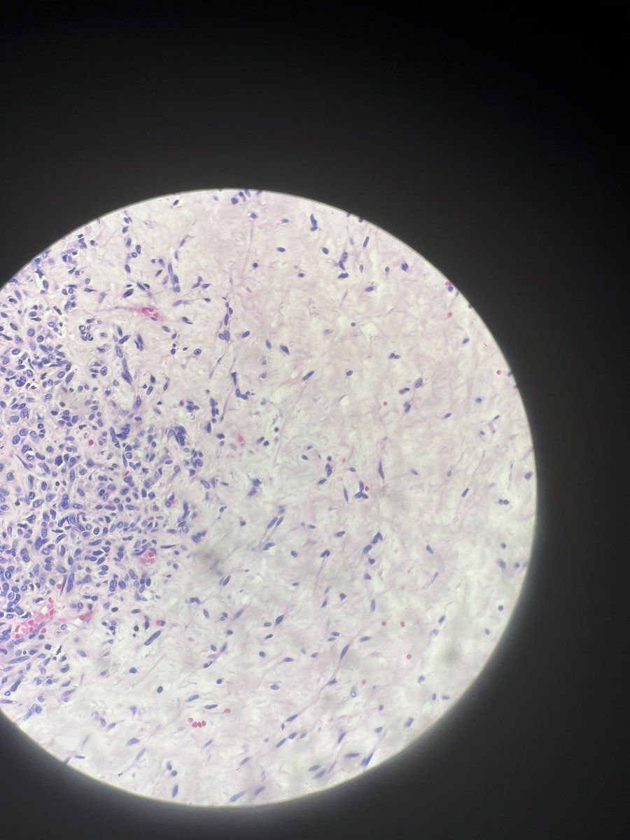 Heather29372982's tweet image. Check out this doozy of a case! It came to us with very little history. We only knew that the patient is 5 years old and had a posterior fossa lesion and a colonic polyp. Top two photos are the brain lesion; bottom two are from colon. Thoughts?