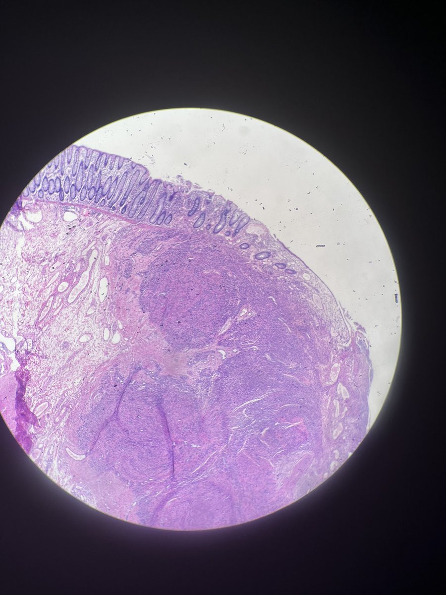Heather29372982's tweet image. Check out this doozy of a case! It came to us with very little history. We only knew that the patient is 5 years old and had a posterior fossa lesion and a colonic polyp. Top two photos are the brain lesion; bottom two are from colon. Thoughts?