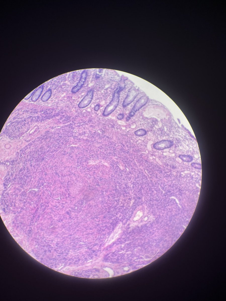 Heather29372982's tweet image. Check out this doozy of a case! It came to us with very little history. We only knew that the patient is 5 years old and had a posterior fossa lesion and a colonic polyp. Top two photos are the brain lesion; bottom two are from colon. Thoughts?