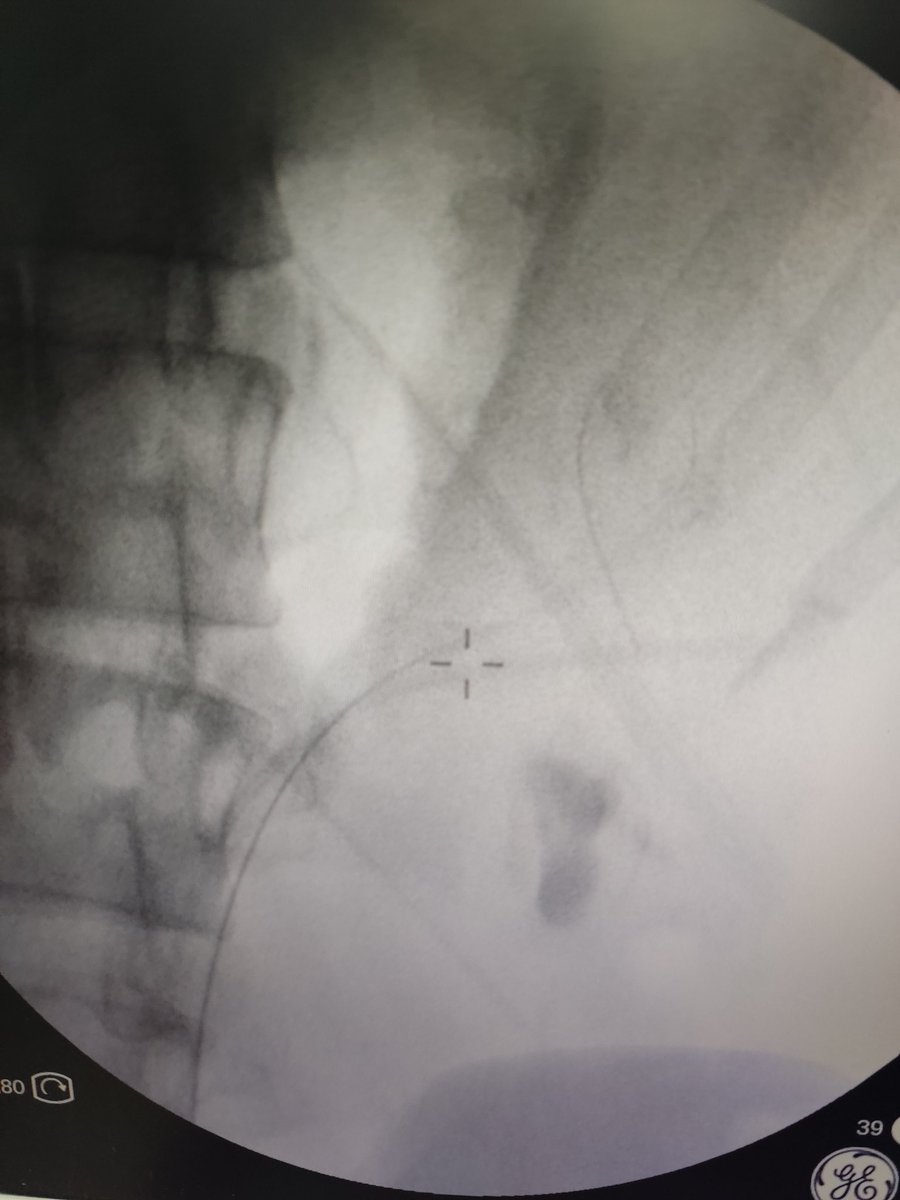 drdenizhan's tweet photo. Today i performed first supine mini-pcnl in our clinic and our city. 😀 34mm staghorn stone, 18fr sheat, tubeless and stonefree. 
Thanks to my mentor in stone @ytanidir

#urosome 
@eauesut
@eulis_uroweb
@Uroweb 
@so_uro @PETRAurogroup @beunedutr @zbeuhastane https://t.co/O5kisX4DTp