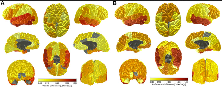 The Lothian Birth Cohorts (@edinunilbc) on Twitter photo Some of the LBC1921s have #brain imaging data at age ~92 years, which is very rare, especially with their #cognitive data at age 11.
Here's a paper which brought both LBC cohorts together to look at brain and cognitive #ageing:
edin.ac/3mt7i04
<a href="/EdinUniImaging/">Edinburgh Imaging 💙</a> Some of the LBC1921s have #brain imaging data at age ~92 years, which is very rare, especially with their #cognitive data at age 11.
Here's a paper which brought both LBC cohorts together to look at brain and cognitive #ageing:
edin.ac/3mt7i04
<a href="/EdinUniImaging/">Edinburgh Imaging 💙</a>
