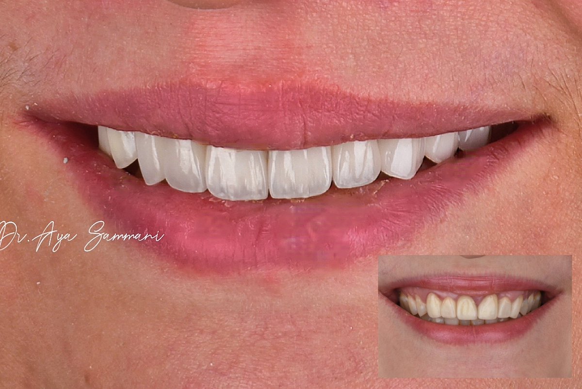 إعادة تصميم الابتسامة ورسم خط الابتسام