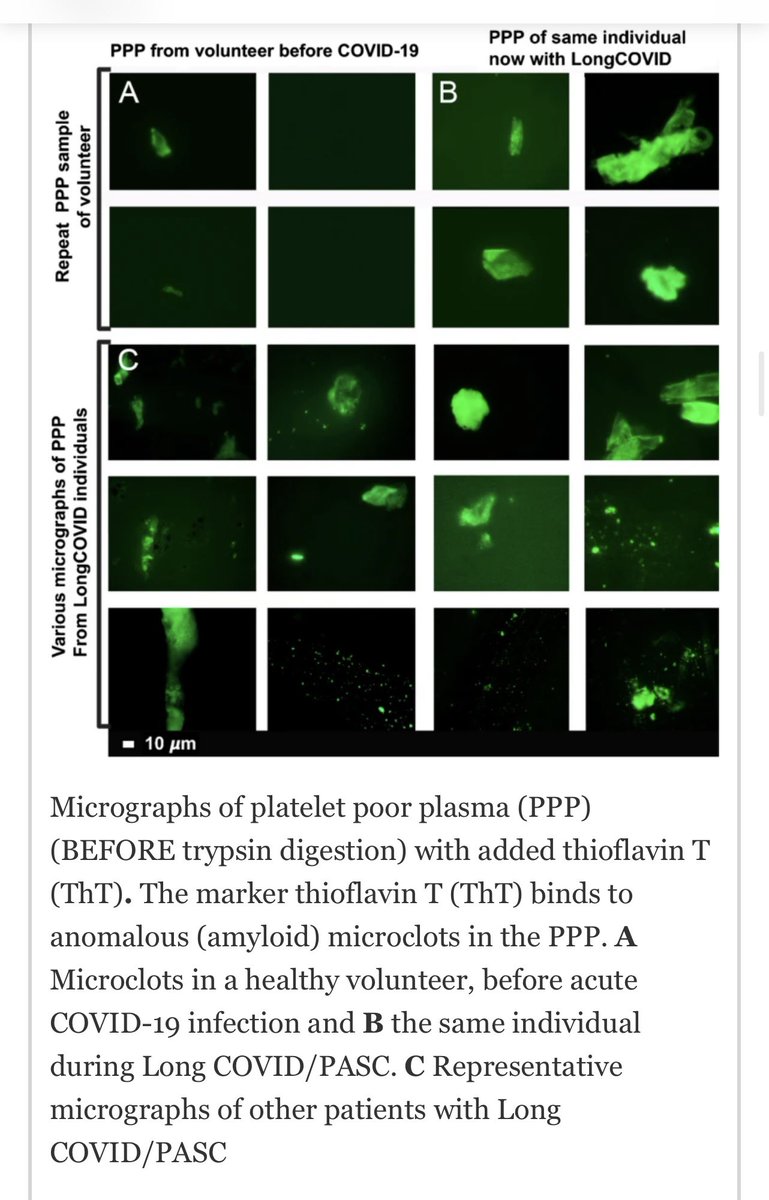 6/ Now to more exciting stuff. Covid causes micro clots  with amyloid. Yes amyloid. They block capillaries and reduce oxygenation. Here is a photo of a patient’s blood before Covid and afterwards when they got  #LongCovid showing new microclots  https://cardiab.biomedcentral.com/articles/10.1186/s12933-021-01359-7