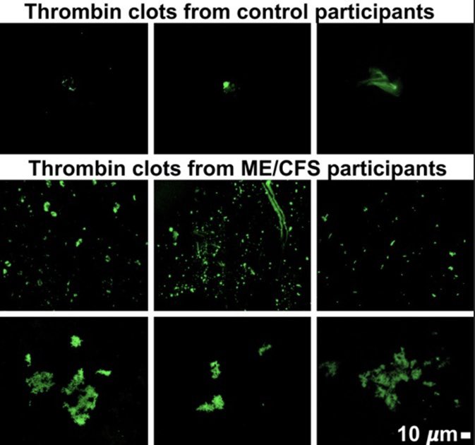 9/  #LongCovid is a post viral illness. Therefore it has not surprised me today to see the pre-print showing the same microclots in  #MECFS  https://www.researchsquare.com/article/rs-1727226/v1 This will not show up in blood tests done currently for  #MECFS or  #LongCovid resulting in ‘but your bloods are normal’