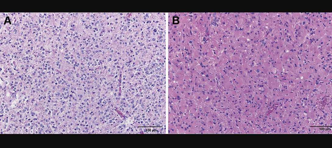 Evolving diagnostic criteria makes historical data review challenging. Congrats to <a href="/ARodrigues121/">Adrian Rodrigues, MD</a>  and colleagues on helping to clarify outcomes in rare #braintumors. <a href="/WorldNeurosurg/">World Neurosurgery Journal</a> 
bit.ly/3xqP59D
