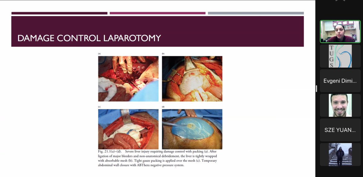 Excellent talk by Dr Baila Maqbool on on Blunt and penetrating abdominal trauma. Please provide your feedback:bit.ly/3PIj5EO. Follow this page for future MRCS teaching sessions!