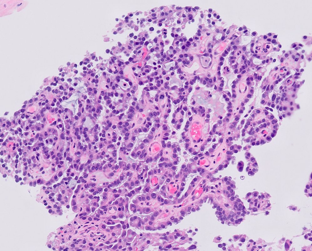 chemily7's tweet photo. beautiful clear cell adenocarcinoma of the urinary tract (male patient)! essentially equivalent to CCC in gyn world. may mimic nephrogenic adenoma by morphology and IHC but solid areas, cytologic atypia, mites and necrosis are clues.  #gupath https://t.co/bX8m7H3ldP