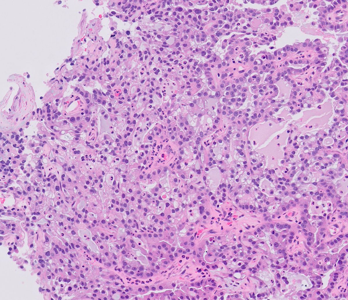 chemily7's tweet photo. beautiful clear cell adenocarcinoma of the urinary tract (male patient)! essentially equivalent to CCC in gyn world. may mimic nephrogenic adenoma by morphology and IHC but solid areas, cytologic atypia, mites and necrosis are clues.  #gupath https://t.co/bX8m7H3ldP
