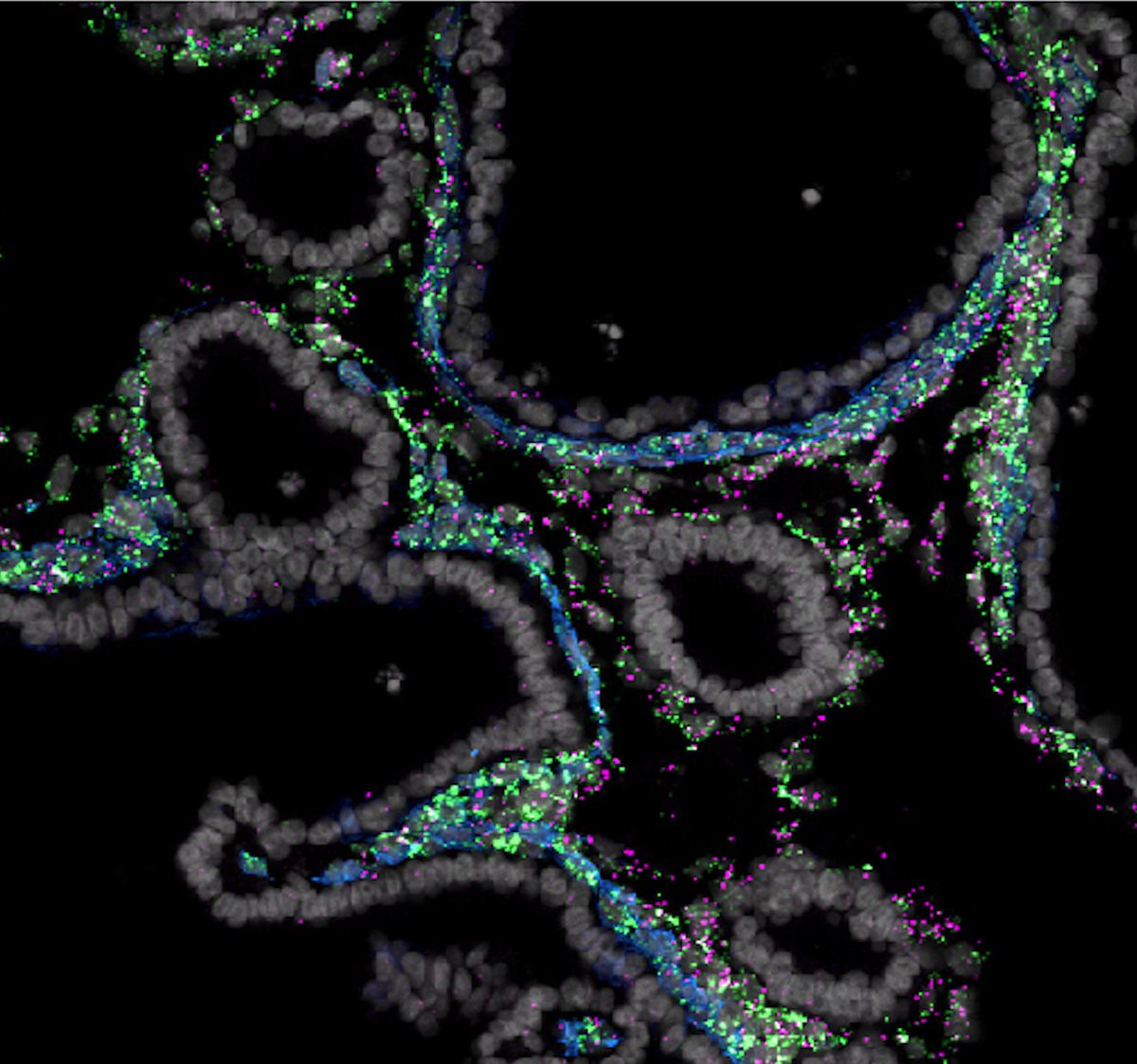 Jason Spence (@thespencelab) on Twitter photo Huge congrats to <a href="/UMCDB/">UMCDB</a> PhD student <a href="/ReneeConway/">Renee Conway Hein</a> and team (<a href="/joshhwu/">Joshua Wu</a> @tristanfrum <a href="/_Alyssa_J_/">Alyssa J Miller, PhD</a> and collaborators)!
R-SPONDIN2+ mesenchymal cells form the bud tip progenitor niche during human lung development, in <a href="/Dev_Cell/">Developmental Cell</a>
cell.com/developmental-…
#organoids Huge congrats to <a href="/UMCDB/">UMCDB</a> PhD student <a href="/ReneeConway/">Renee Conway Hein</a> and team (<a href="/joshhwu/">Joshua Wu</a> @tristanfrum <a href="/_Alyssa_J_/">Alyssa J Miller, PhD</a> and collaborators)!
R-SPONDIN2+ mesenchymal cells form the bud tip progenitor niche during human lung development, in <a href="/Dev_Cell/">Developmental Cell</a>
cell.com/developmental-…
#organoids