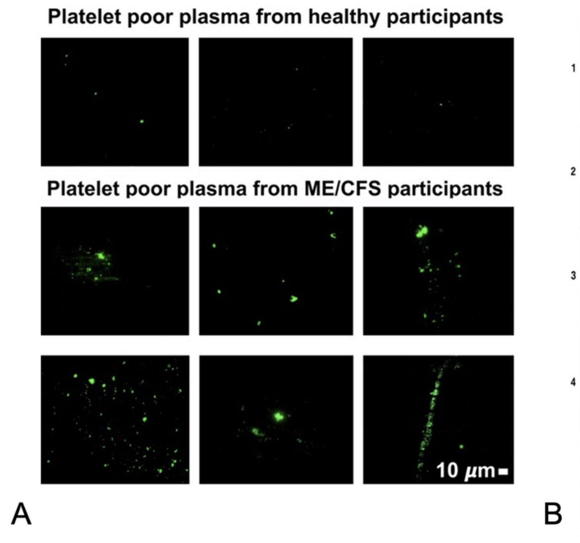 microbeminded2's tweet image. So it turns out we did find “something in the blood” of #ME/CFS patients: fibrinaloid microclots + hyperactivated platelets (that you can see with your own eyes). Thank you so much to @polybioRF donors who helped support part of the study: researchsquare.com/article/rs-172…