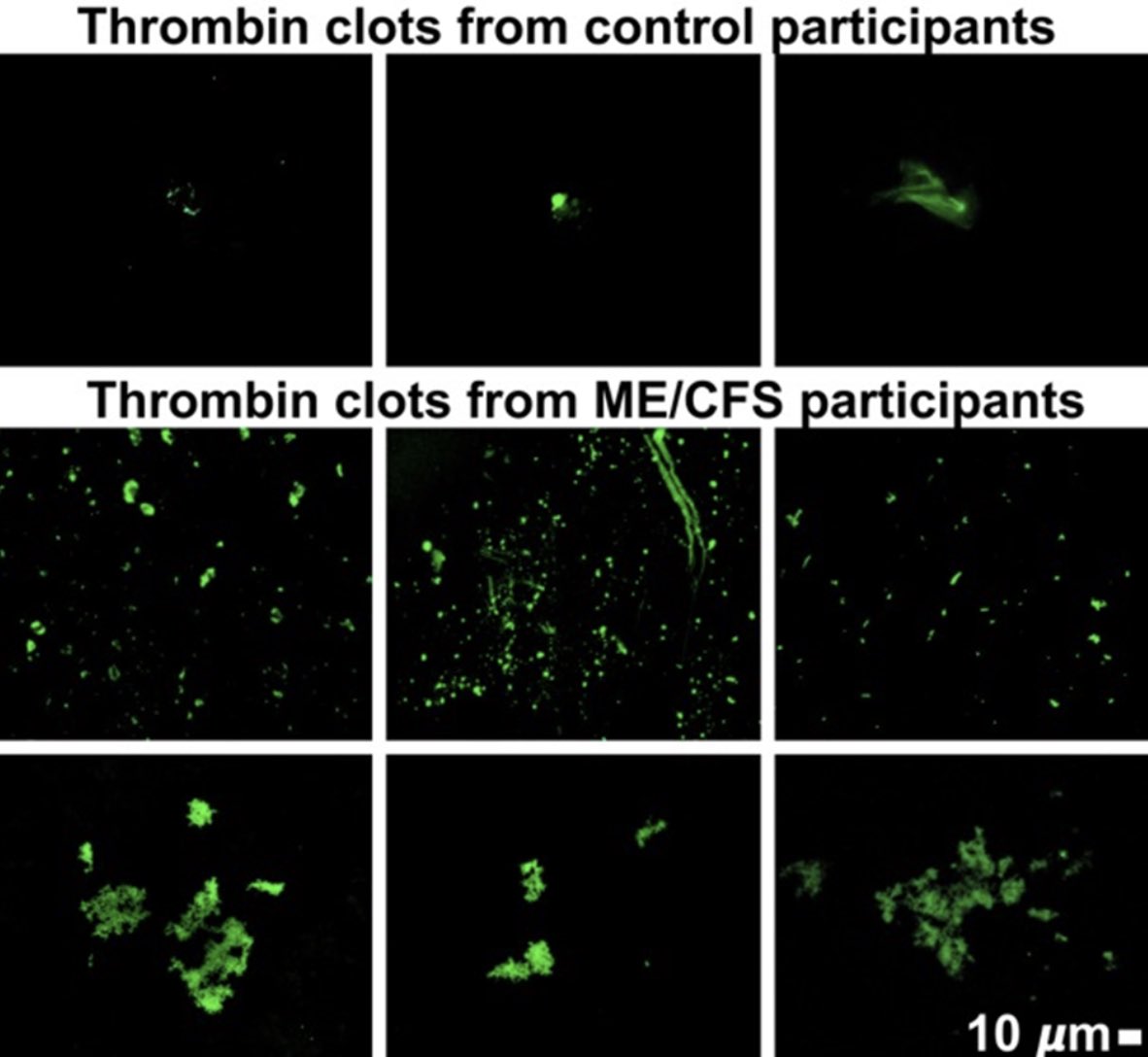 microbeminded2's tweet image. So it turns out we did find “something in the blood” of #ME/CFS patients: fibrinaloid microclots + hyperactivated platelets (that you can see with your own eyes). Thank you so much to @polybioRF donors who helped support part of the study: researchsquare.com/article/rs-172…