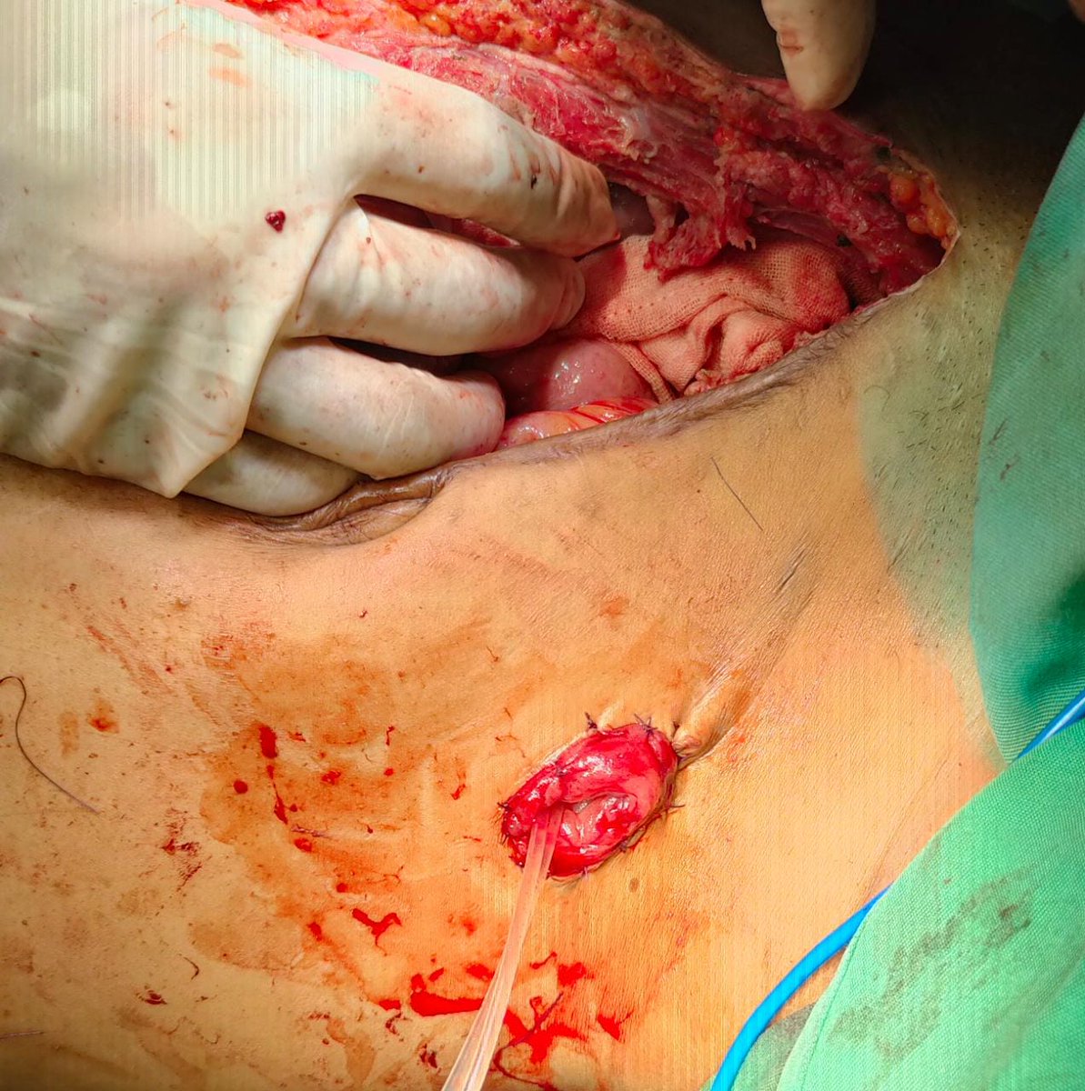 Bismillaah
Suatu ketika sy operasi bareng teman sy dr @SyamsuHudaya urolog konsultan tumor RSUP Fatm...