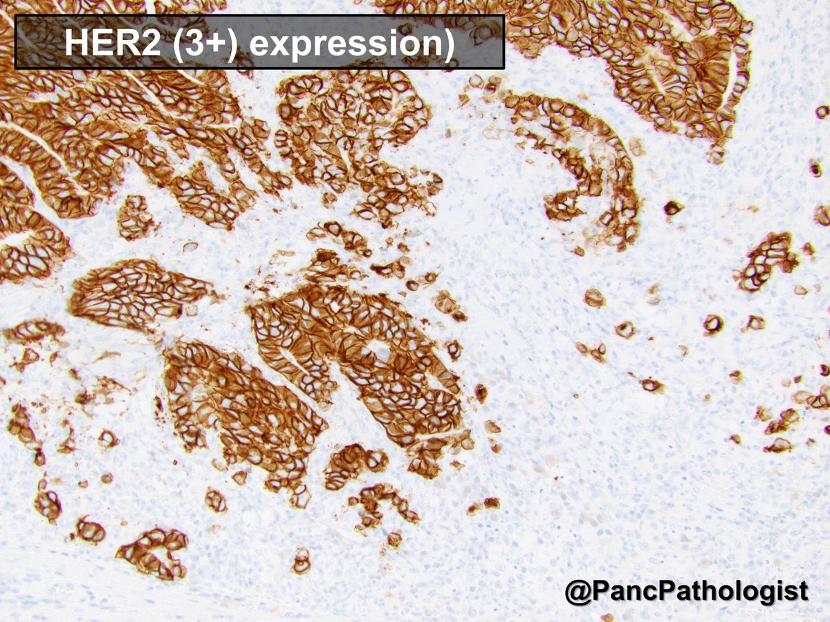 <a href="/SoMeCME/">Integrity CE SoMe CME</a> Another example, of a non-gastric/GEJ cancer that can be HER2 (3+) positive and ERBB2 amplified: #gallbladder adenocarcinoma #GIPath #Pathology