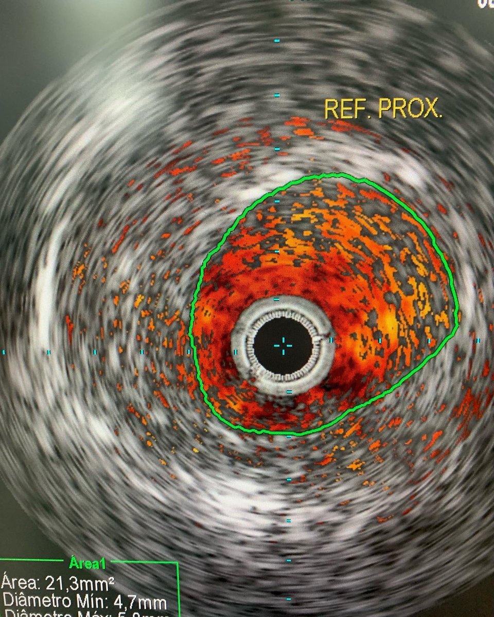 lbncbma's tweet photo. Angioplastia de Carótida com IVUS, Sistema de Proteção Cerebral e Stent. Caso com Hiperplasia Miointimal e Progressão de Doença Aterosclerótica. 
#endovascularsurgery #PTA #criticallimbIschemia #thinkaorta  #medtwitter
#aneurysm #practicemakesperfect #vasculartraining #carotida https://t.co/aZcjyXSd9V