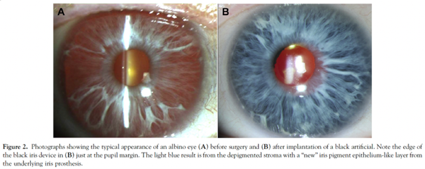 TheLens_oph's tweet image. CustomFlex, a unique foldable iris prosthesis 👁️, received FDA approval in 2018. Read more on its recent landmark trial ➡️ @AAOjournal pubmed.ncbi.nlm.nih.gov/35131359/ 
#MedTwitter #CustomFlex