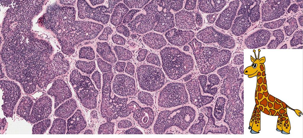 People starting out sometimes get spiradenoma and cylindroma confused (which doesn't matter and they sometimes overlap!). Remember SPiradenoma has Salt and Pepper lymphocytes, cylindroma looks like the cylindrical neck of a giraffe. #dermpath #dermatology #pathology