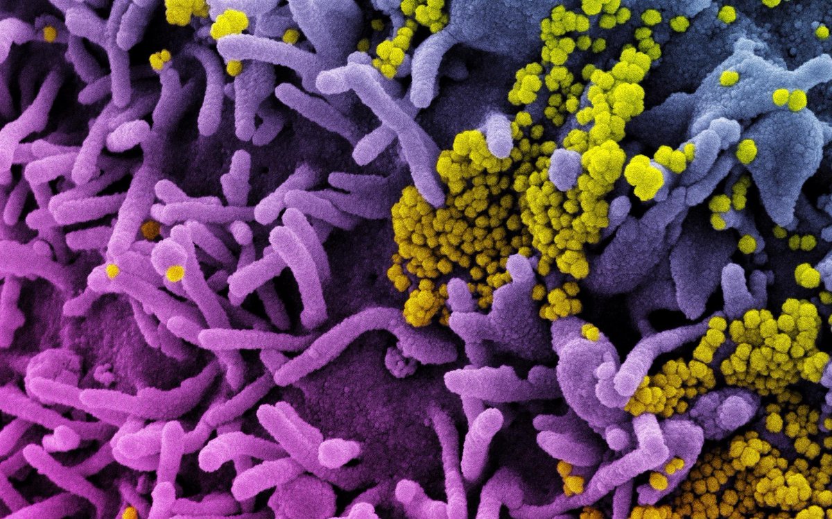 NewsMedical's tweet photo. SARS-CoV-2 ORF8 protein binds to dendritic cells and induces a hyper-inflammatory cytokine storm https://t.co/aC7zxfYPXR #Cytokine #SpikeProtein #SARSCoV2 #Coronavirus #Disease #COVID #ORF8 #CytokineStorm @biorxivpreprint @UniCologne @UManitoba https://t.co/1kS5ukdRtU