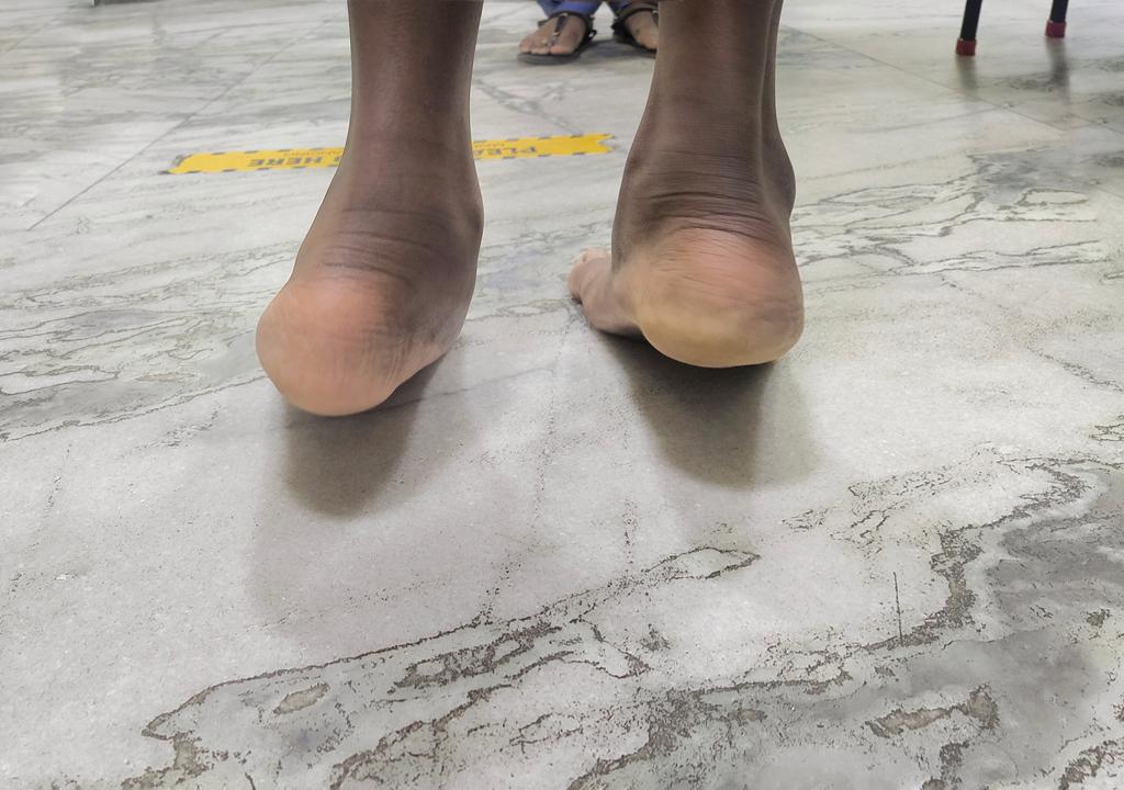 childortho's tweet photo. A simple test to distinguish rigid and flexible #flat #foot. Just make child tip toe.
The heel on the left is stuck in valgus but the right heel moves into varus from valgus. The #subtalar joint on left is not mobile. The peroneal tendons are tight.
#orthotwitter
#medtwitter https://t.co/1j5efYEqTE