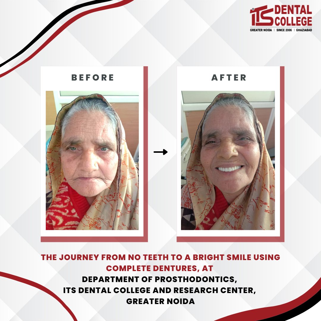 The journey from no teeth to a bright smile using complete dentures, at the Department of Prosthodontics, ITS Dental College and Research Center, Gr. Noida ❤️✨
.
#ITSDentalCollege, #DepartmentOfProsthodontics, #Prosthodontics #HappyPatientHappyUs #OralRehabilitation