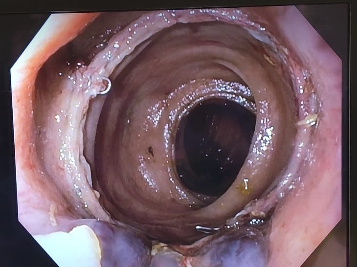 PerePlanellas's tweet photo. Formación Fellowship #colorectal @AECP_FAECP + Formación MIR en Cirugía General y Digestiva en @Htrueta de Girona. @ernestobarzola8 y @bertatioo 💪💪💪

Combinación de asistencia, formación continuada/docencia y investigación https://t.co/nWhhXWoTqV