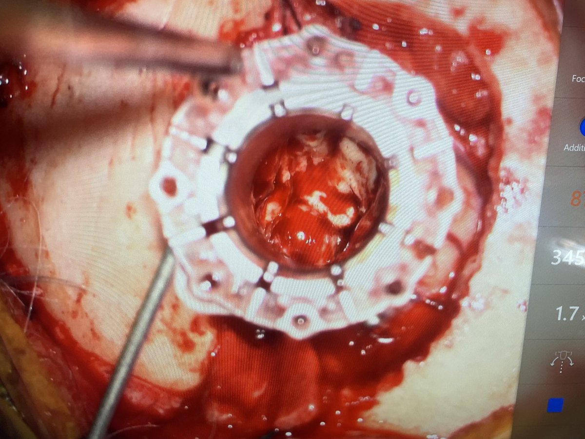 ARODMDPHD's tweet photo. Down the rabbit hole…
#brainpath #neurosurgery #mininvasivesurgery https://t.co/vm61ufKAtF