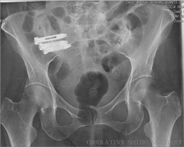 NeurosurgeryCNS's tweet photo. #ONSNew Sacroiliac Joint Fusion Using Robotic Navigation: Technical Note and Case Series https://t.co/ldLECqfmoX by @y_timothy @KhoiThanMD @DukeMedSchool @CNS_Update @JohnHShinMD https://t.co/BLjxyRmOIf