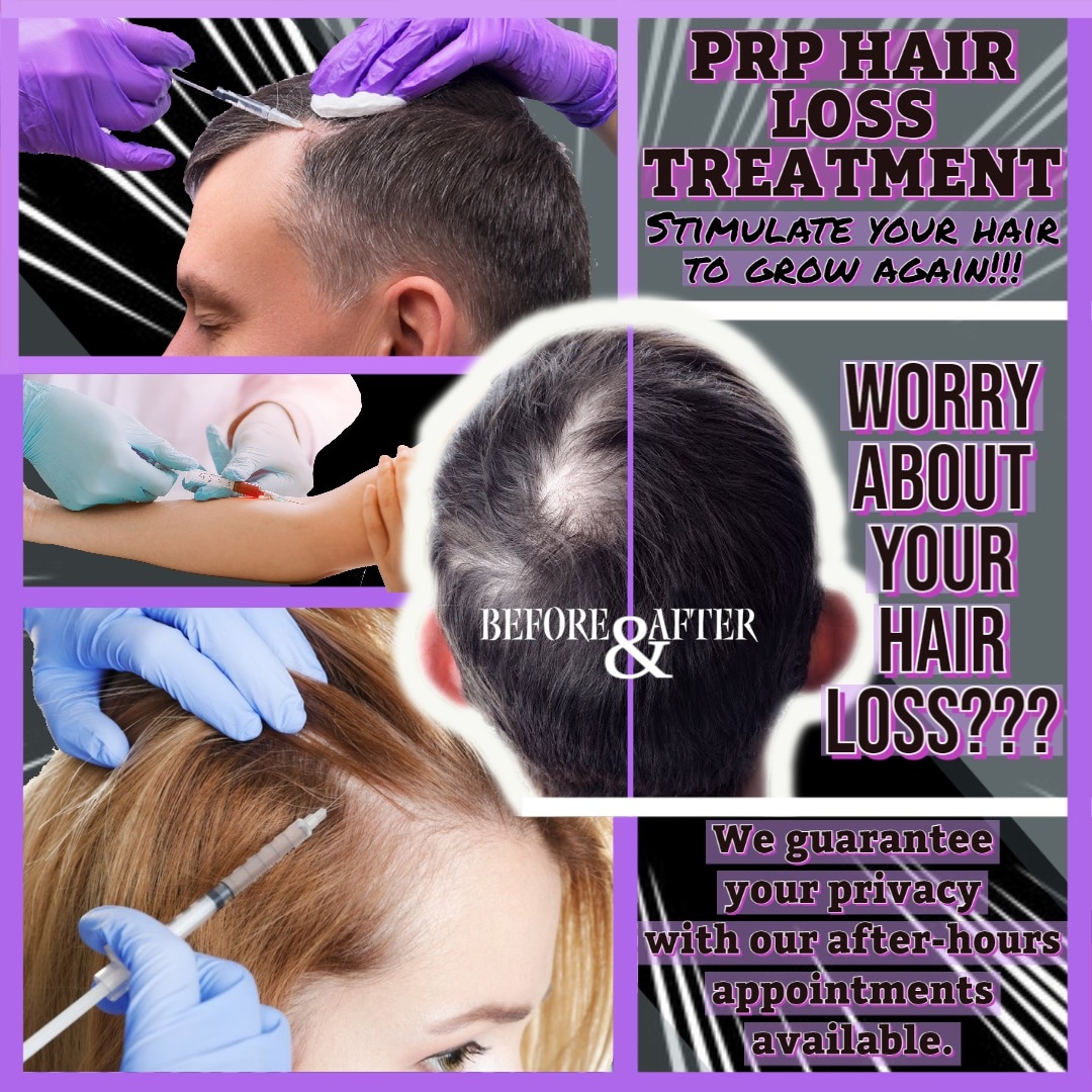 DylanexZoo's tweet photo. #hairtransplant #hair #Chester #prp #prf #happy #hairloss https://t.co/yHmv57niK2
