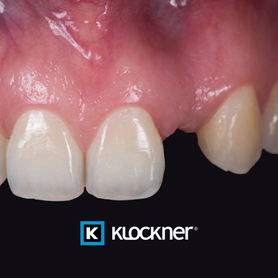 klocknerES's tweet image. Good bless bone reconstruction!

#casoclínico #klockner #klockneres #freedomisnotfixed