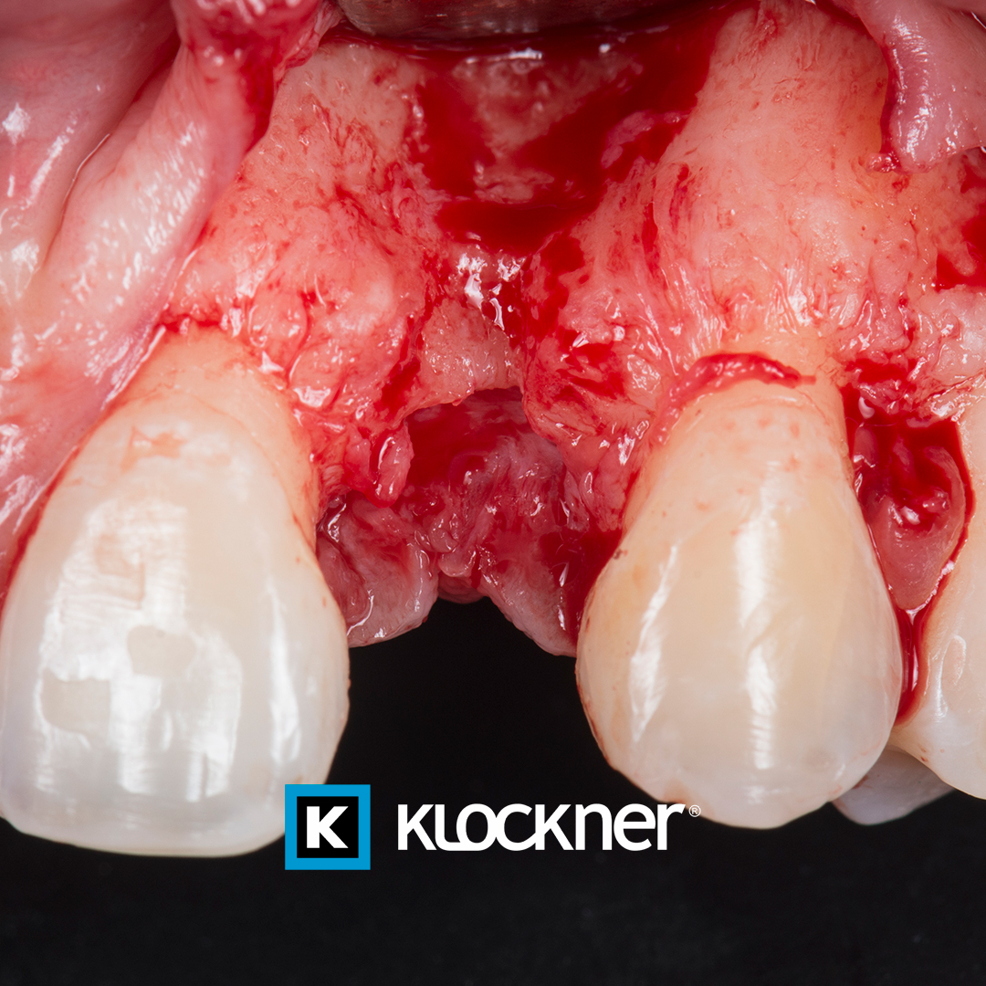 klocknerES's tweet image. Good bless bone reconstruction!

#casoclínico #klockner #klockneres #freedomisnotfixed