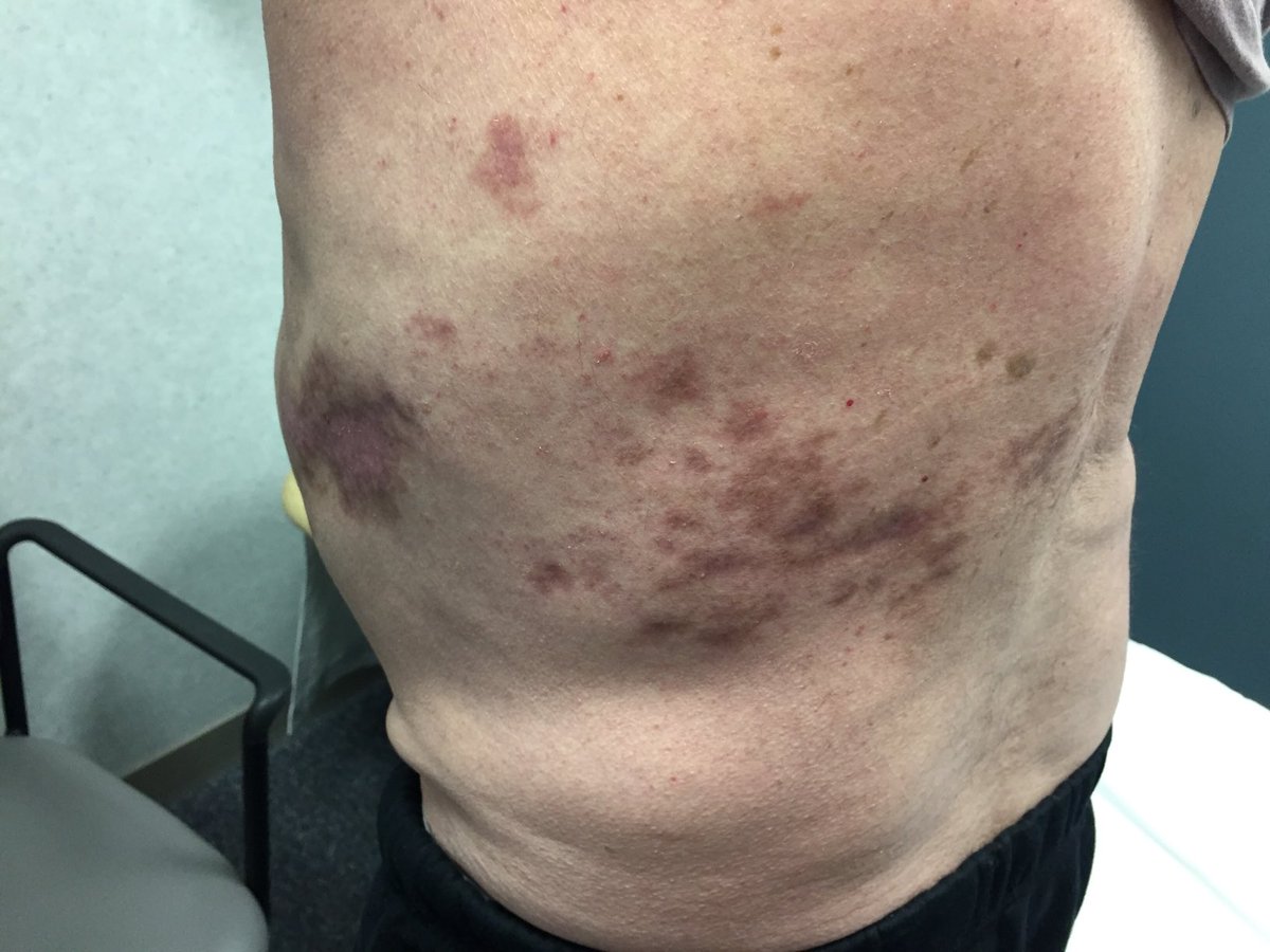 Janetbirdope's tweet photo. #ClinicalPearl What dx did this pt have? hint pt was on prednisone and has #SLE. Now shooting pain. https://t.co/xQ7ptHZ4SR