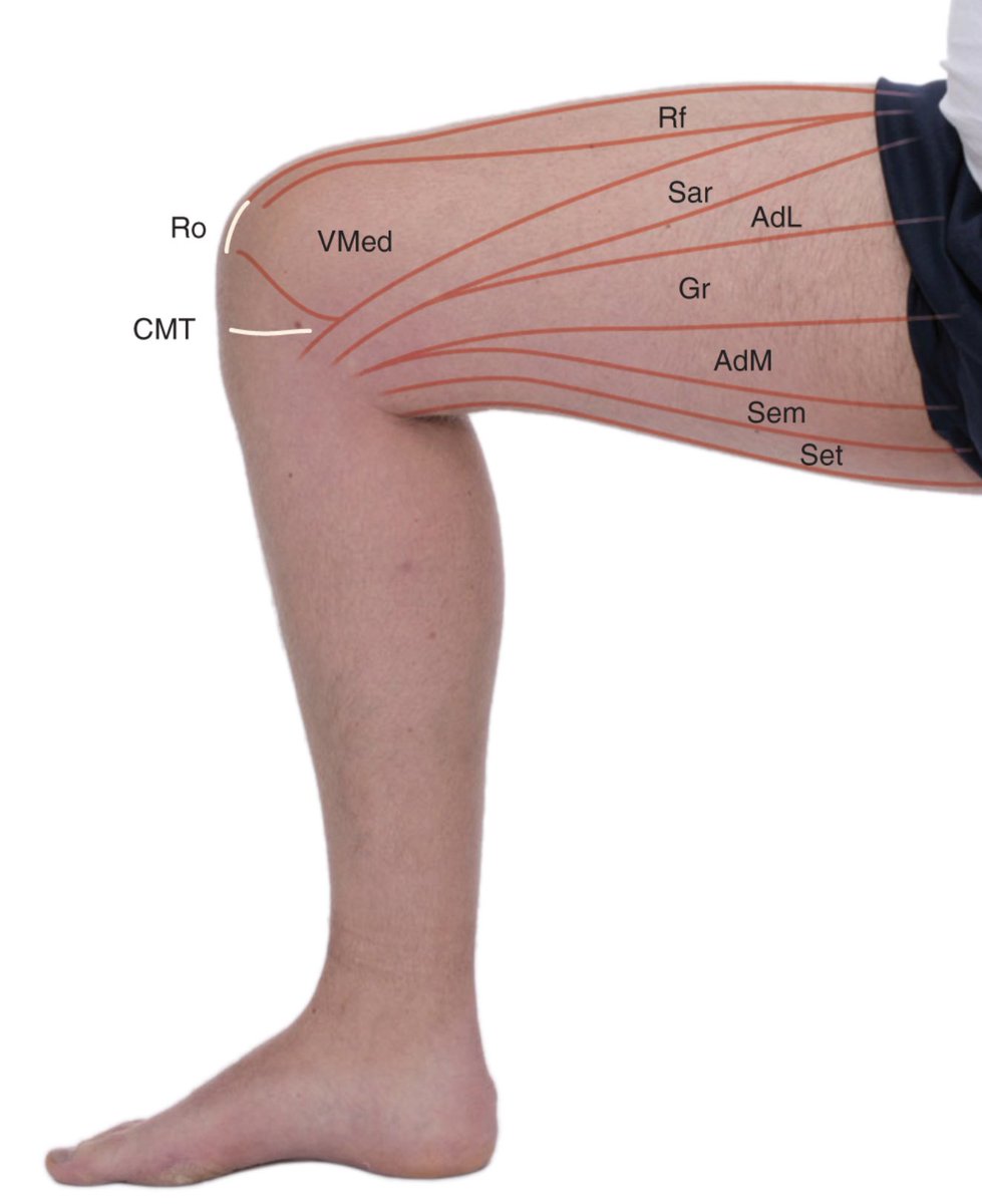 Proyecciones en superficie los músculos en la cara medial del muslo 📌 AdL:  m. aductor largo 📌 AdM: m. aductor mayor 📌 Gr: m. grácil 📌 Rf: m. recto  femoral 📌 Sar:, image size:979x1200