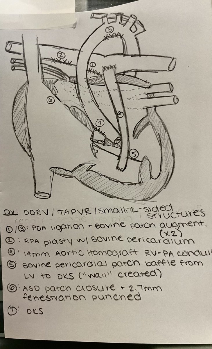 MujeebZubair's tweet image. Picture by Gina Ubertini. Phenomenal icu nurse , who draws pictures after surgeries. See below for DORV/ TAPRV/ small L sided structure repair. 

Congenital cardiac surgery is just amazing