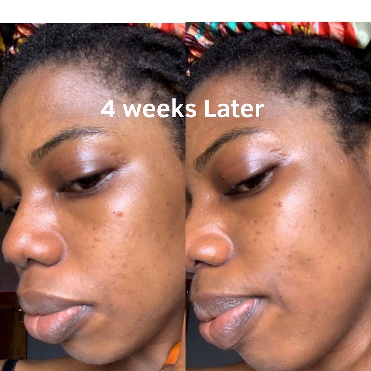 Review O’clock✨ 
A client’s testimonial. 

Check out to see her progress. A thread👇🏽

#skincare #skincareroutine #skincarejourney #lemonskinco