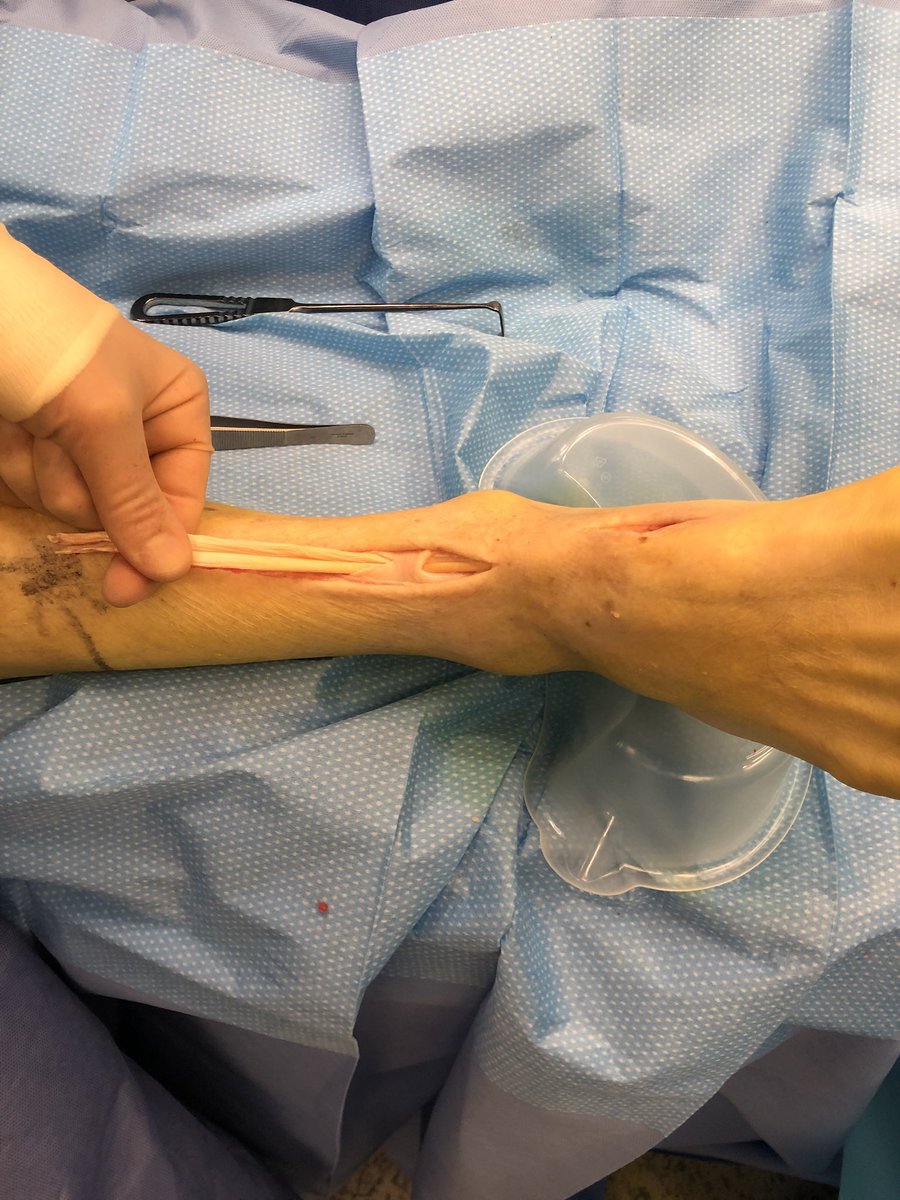 Representing <a href="/HarrogateNHSFT/">Harrogate NHS FT</a> at #EFORT2022 in Lisbon.
Presenting our experience using autologous hamstring grafts for foot &amp; ankle tendon reconstruction.
<a href="/duffykneesurg/">David Duffy</a> <a href="/yorkskneeclinic/">Yorkshire Knee Clinic (YKC)</a>