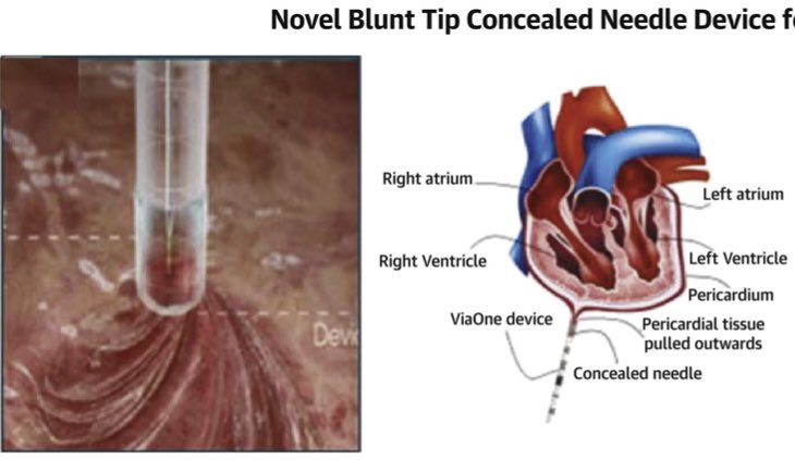 DJ Lakkireddy (@dj_lakkireddy) on Twitter photo Innovations in pericardial Access pulling the pericardium away from the heart - making it safer and easier. @Viaone from @Cardiovia <a href="/ZivMenshes/">זיו מנשס</a> <a href="/HRSonline/">Heart Rhythm Society</a> <a href="/ACCinTouch/">American College of Cardiology</a> <a href="/JACCJournals/">JACC Journals</a> <a href="/shivkumarmd/">Kalyanam Shivkumar MD PhD</a> doi.org/10.1016/j.jace… <a href="/KcHeartrhythm/">KCHRI</a> <a href="/drrakeshg1/">Rakesh Gopinath</a> <a href="/krishpothineni/">Krishna Pothineni</a> <a href="/Adnan_AhmedMD/">Adnan Ahmed</a> Innovations in pericardial Access pulling the pericardium away from the heart - making it safer and easier. @Viaone from @Cardiovia <a href="/ZivMenshes/">זיו מנשס</a> <a href="/HRSonline/">Heart Rhythm Society</a> <a href="/ACCinTouch/">American College of Cardiology</a> <a href="/JACCJournals/">JACC Journals</a> <a href="/shivkumarmd/">Kalyanam Shivkumar MD PhD</a> doi.org/10.1016/j.jace… <a href="/KcHeartrhythm/">KCHRI</a> <a href="/drrakeshg1/">Rakesh Gopinath</a> <a href="/krishpothineni/">Krishna Pothineni</a> <a href="/Adnan_AhmedMD/">Adnan Ahmed</a>