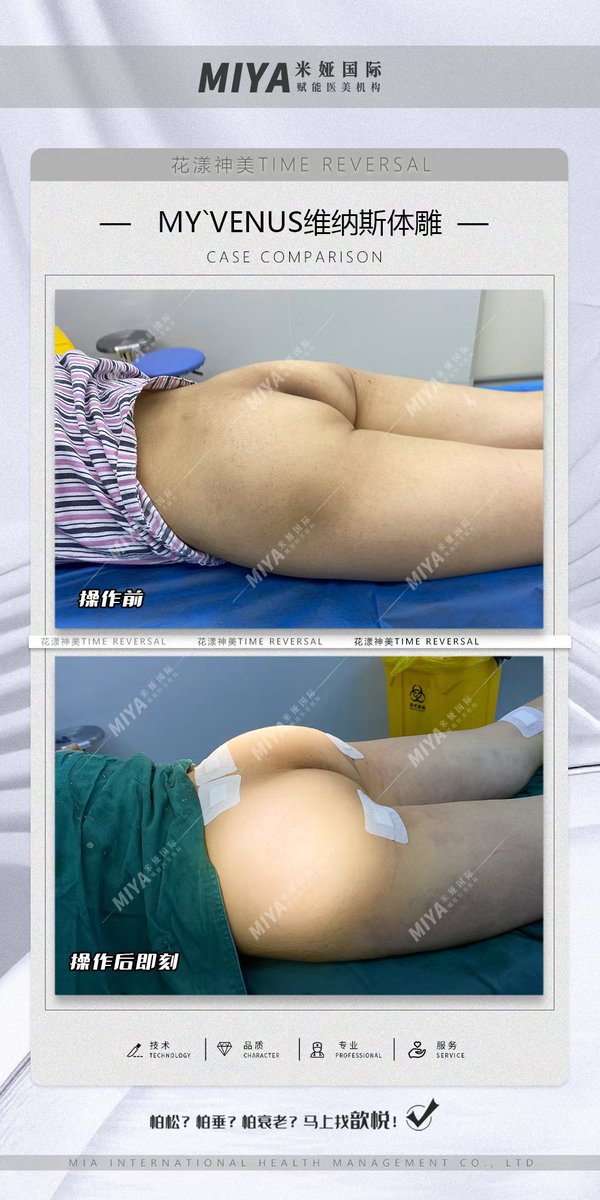 TransgenderHome's tweet photo. 花漾神美｜MY`VENUS维纳斯体雕
改善术前形态扁平 自体脂肪填充后饱满蜜桃臀，火热性感 https://t.co/Oyc3Dum9Z7